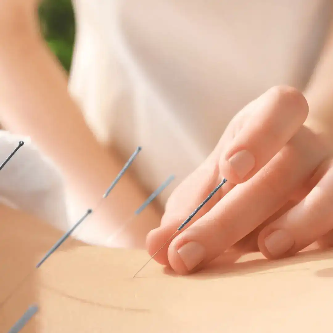 Acupuncture techniques